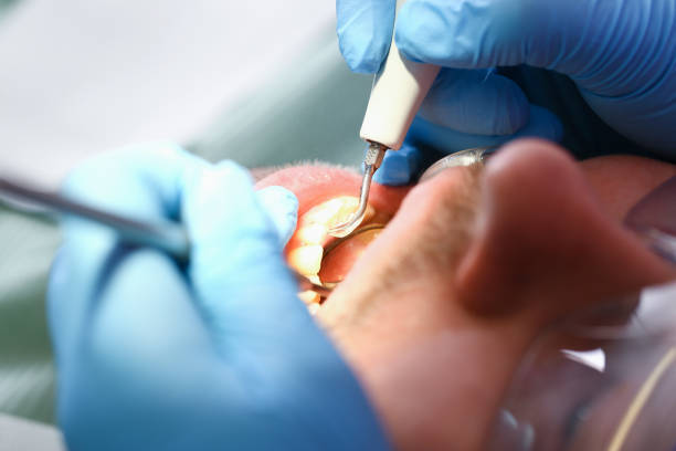 Best Emergency Dental Care for Broken or Chipped Teeth in Whiteland, IN