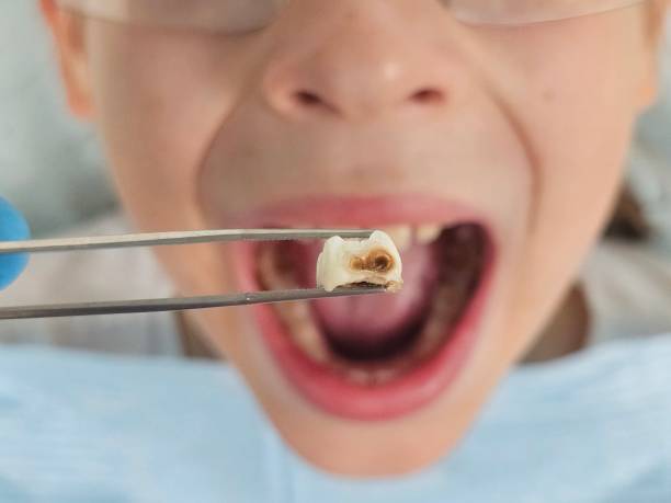 Best Emergency Dental Care for Broken or Chipped Teeth in Whiteland, IN